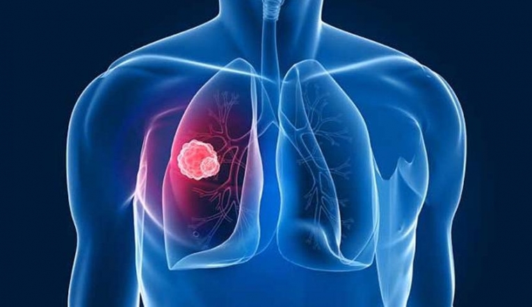 Teşhisi zor, ölüm oranı yüksek: Akciğer Kanseri