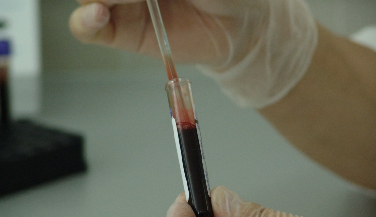 Dünyada 325 milyon hepatit hastası var!
